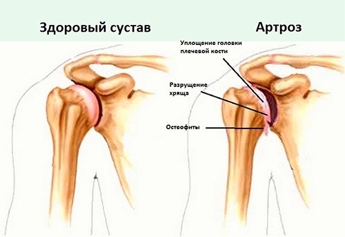Как выглядит артроз плечевого сустава - схема