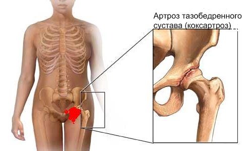 Развитие коксартроза